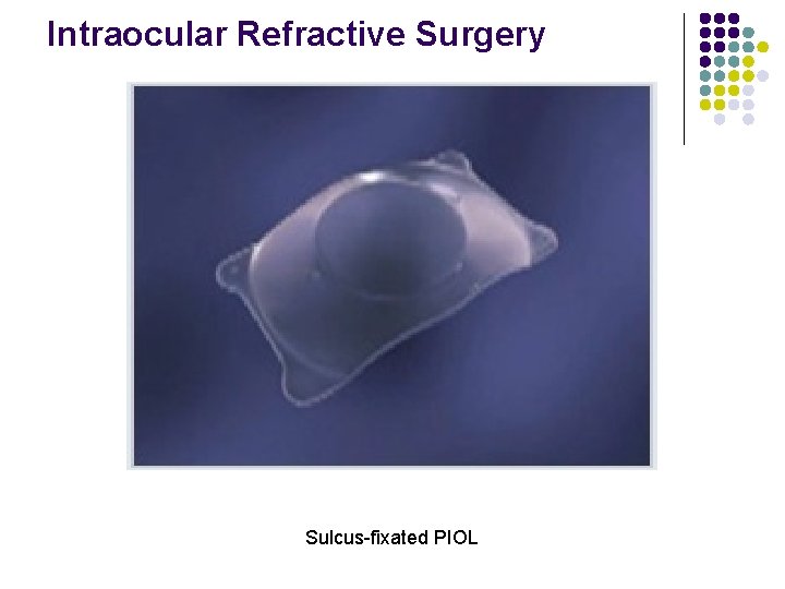 Intraocular Refractive Surgery Sulcus-fixated PIOL 