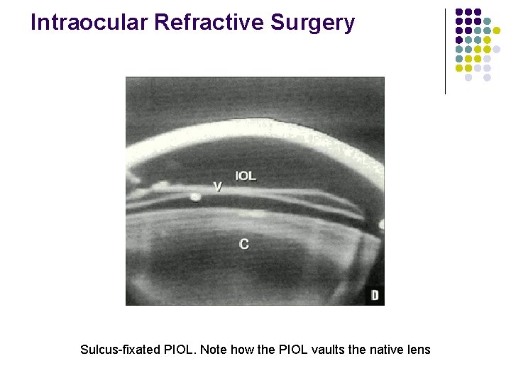 Intraocular Refractive Surgery Sulcus-fixated PIOL. Note how the PIOL vaults the native lens 