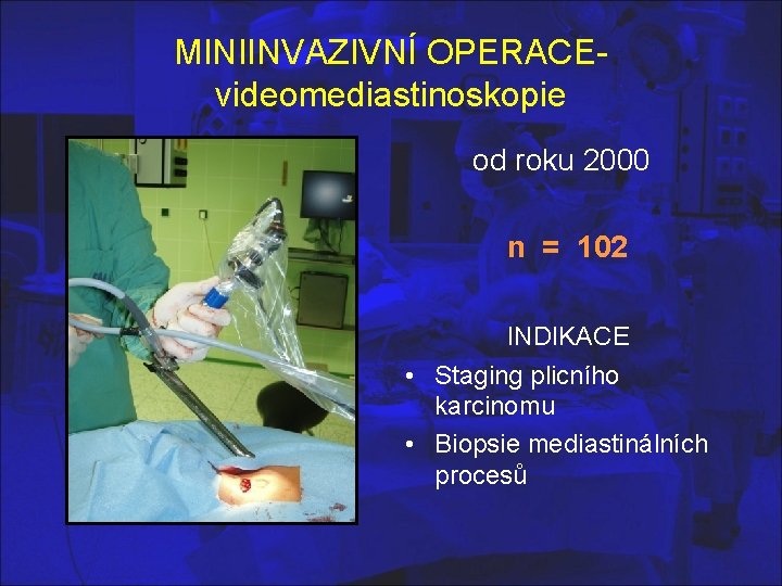 MINIINVAZIVNÍ OPERACEvideomediastinoskopie od roku 2000 n = 102 INDIKACE • Staging plicního karcinomu •