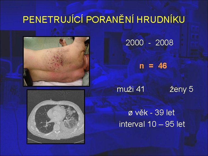 PENETRUJÍCÍ PORANĚNÍ HRUDNÍKU 2000 - 2008 n = 46 muži 41 ženy 5 ø