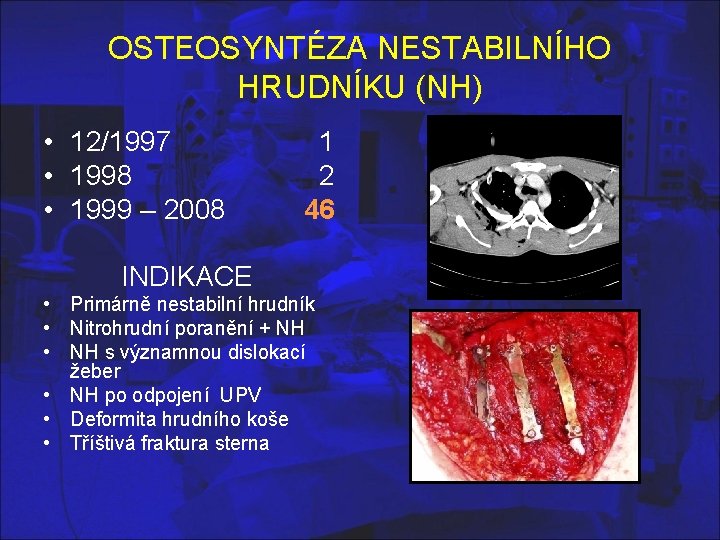 OSTEOSYNTÉZA NESTABILNÍHO HRUDNÍKU (NH) • 12/1997 • 1998 • 1999 – 2008 1 2