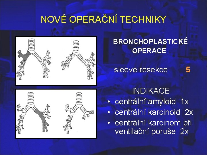 NOVÉ OPERAČNÍ TECHNIKY BRONCHOPLASTICKÉ OPERACE sleeve resekce 5 INDIKACE • centrální amyloid 1 x