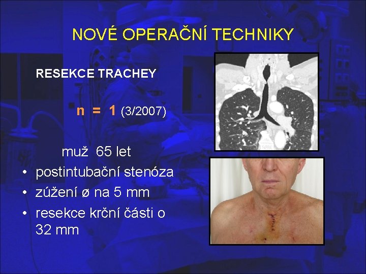 NOVÉ OPERAČNÍ TECHNIKY RESEKCE TRACHEY n = 1 (3/2007) muž 65 let • postintubační NOVÉ OPERAČNÍ TECHNIKY RESEKCE TRACHEY n = 1 (3/2007) muž 65 let • postintubační