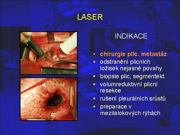 LASER INDIKACE • chirurgie plic. metastáz • odstranění plicních ložisek nejasné povahy • biopsie