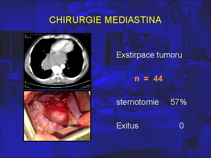 CHIRURGIE MEDIASTINA Exstirpace tumoru n = 44 sternotomie Exitus 57% 0 