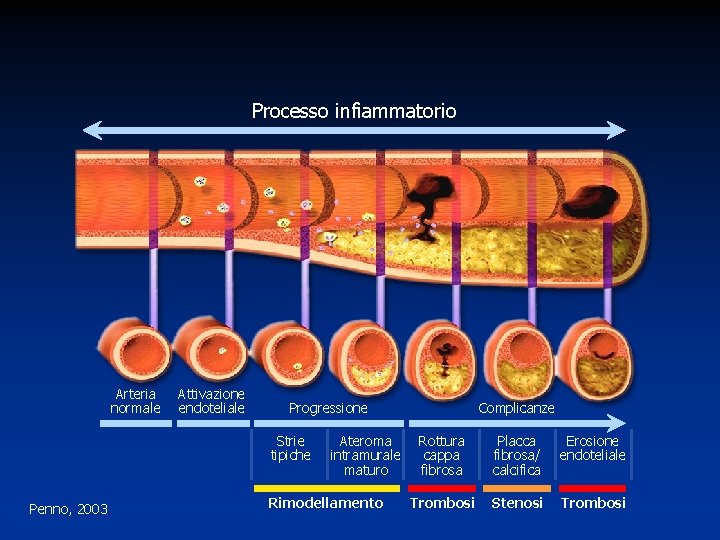 Processo infiammatorio Arteria normale Attivazione endoteliale Progressione Strie tipiche Penno, 2003 Ateroma intramurale maturo