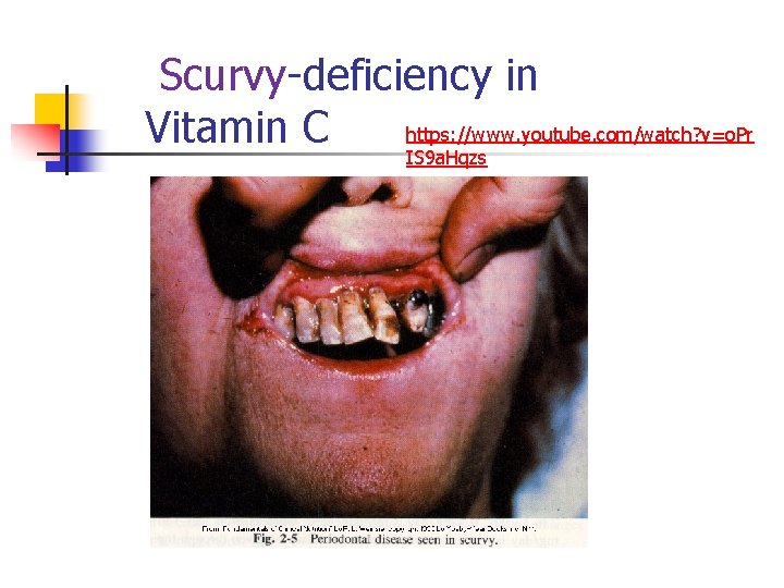 Scurvy-deficiency in https: //www. youtube. com/watch? v=o. Pr Vitamin C IS 9 a. Hqzs