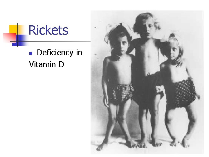 Rickets Deficiency in Vitamin D n 