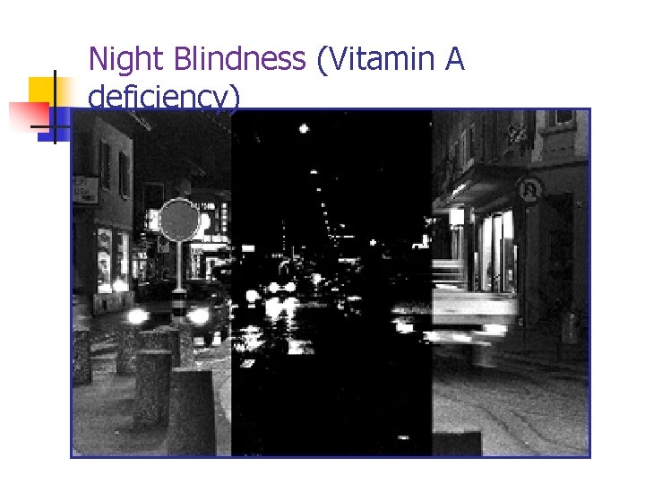 Night Blindness (Vitamin A deficiency) 