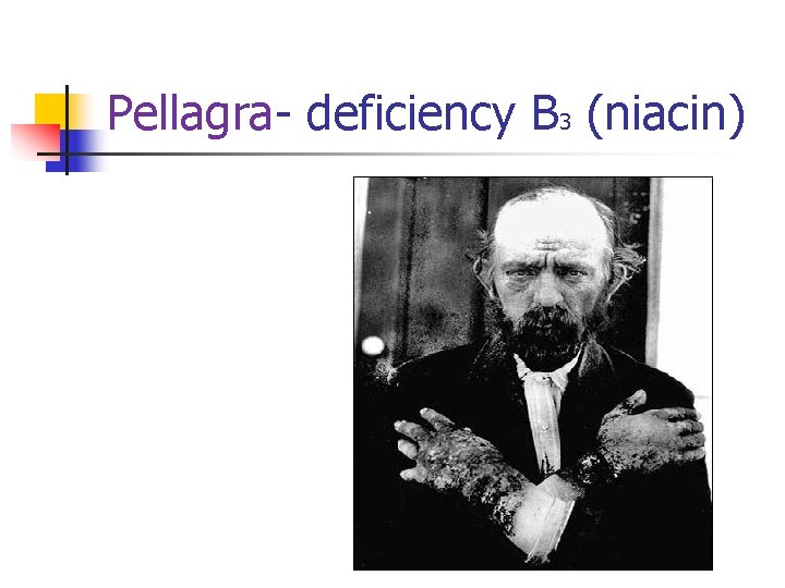 Pellagra- deficiency B 3 (niacin) 