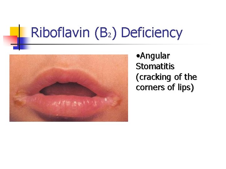 Riboflavin (B 2) Deficiency • Angular Stomatitis (cracking of the corners of lips) 