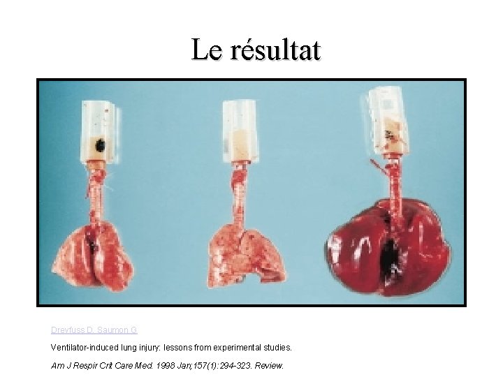 Le résultat Dreyfuss D, Saumon G Ventilator-induced lung injury: lessons from experimental studies. Am