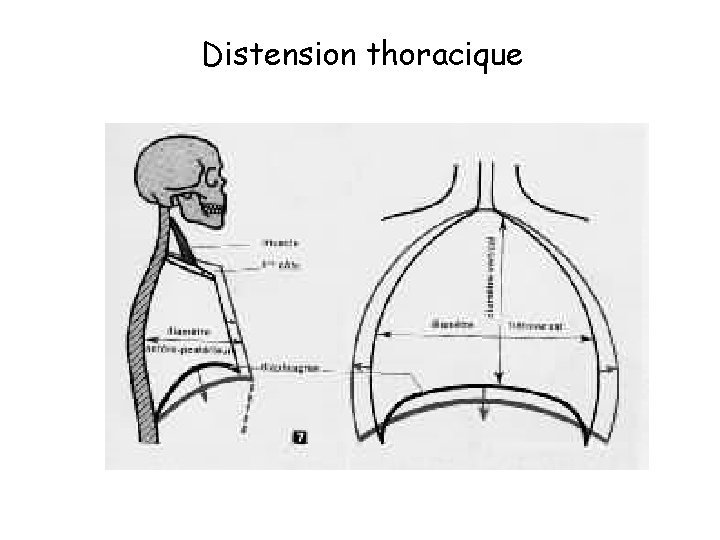 Distension thoracique 
