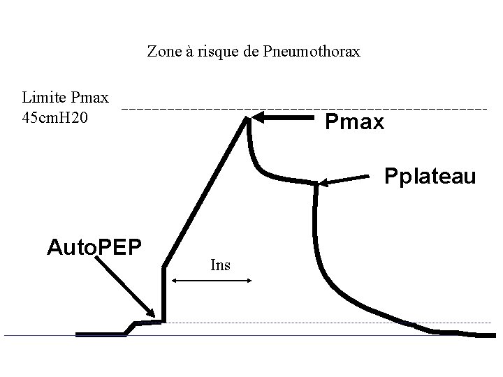  Zone à risque de Pneumothorax Limite Pmax 45 cm. H 20 Pmax Pplateau