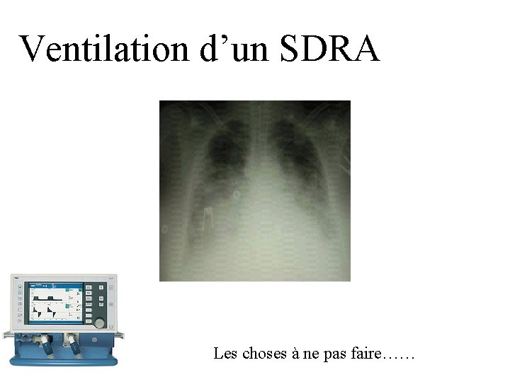 Ventilation d’un SDRA Les choses à ne pas faire…… 