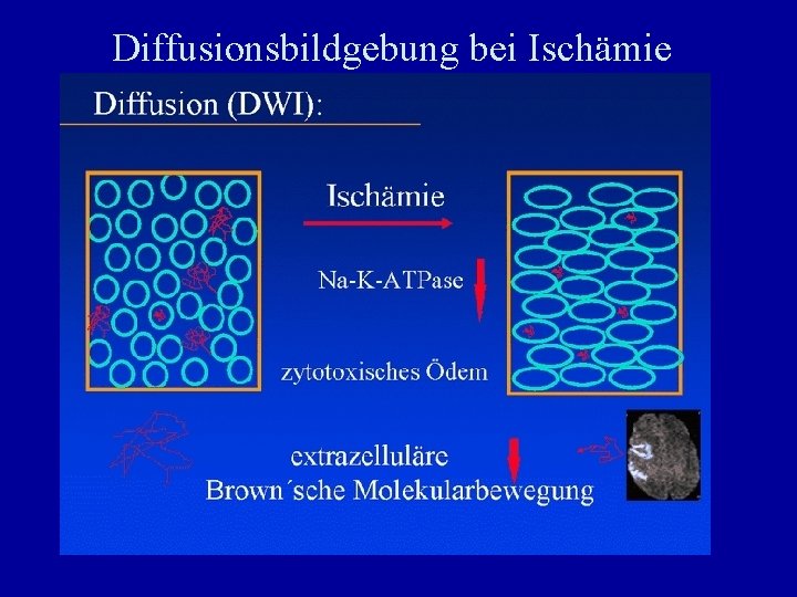 Diffusionsbildgebung bei Ischämie 