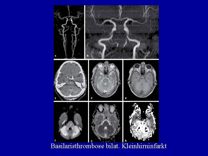 Basilaristhrombose bilat. Kleinhirninfarkt 