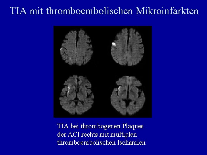 TIA mit thromboembolischen Mikroinfarkten TIA bei thrombogenen Plaques der ACI rechts mit multiplen thromboembolischen