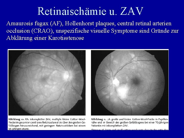 Retinaischämie u. ZAV Amaurosis fugax (AF), Hollenhorst plaques, central retinal arterien occlusion (CRAO), unspezifische