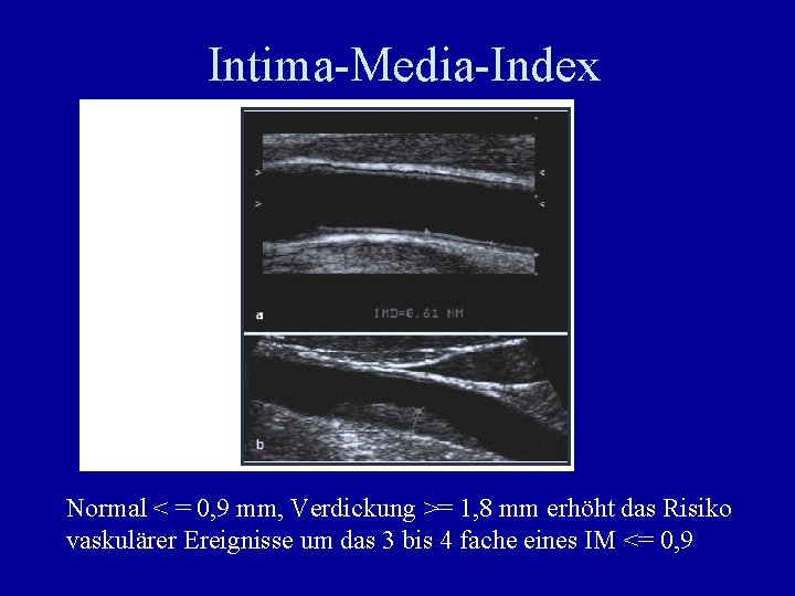 Intima-Media-Index Normal < = 0, 9 mm, Verdickung >= 1, 8 mm erhöht das