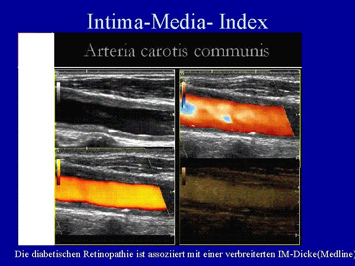 Intima-Media- Index Die diabetischen Retinopathie ist assoziiert mit einer verbreiterten IM-Dicke(Medline) 
