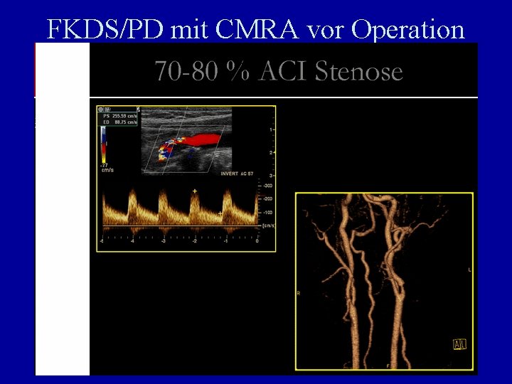 FKDS/PD mit CMRA vor Operation höhergradiger Stenosen 