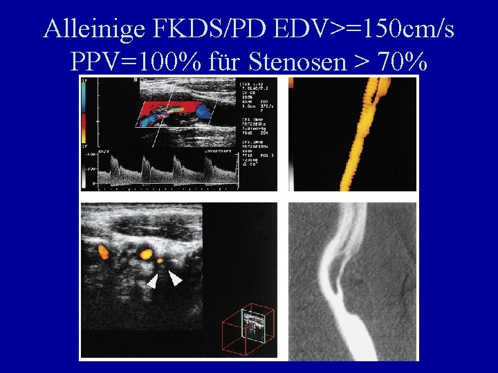 Alleinige FKDS/PD EDV>=150 cm/s PPV=100% für Stenosen > 70% 
