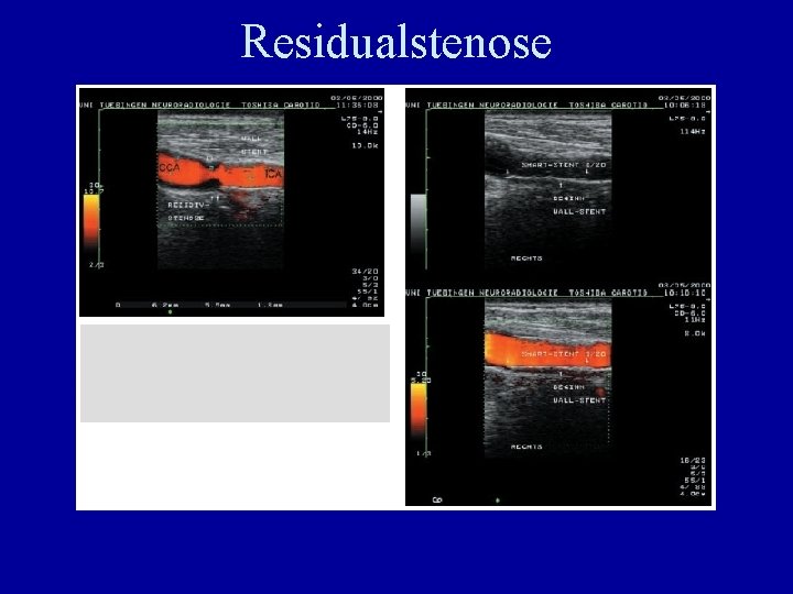 Residualstenose 