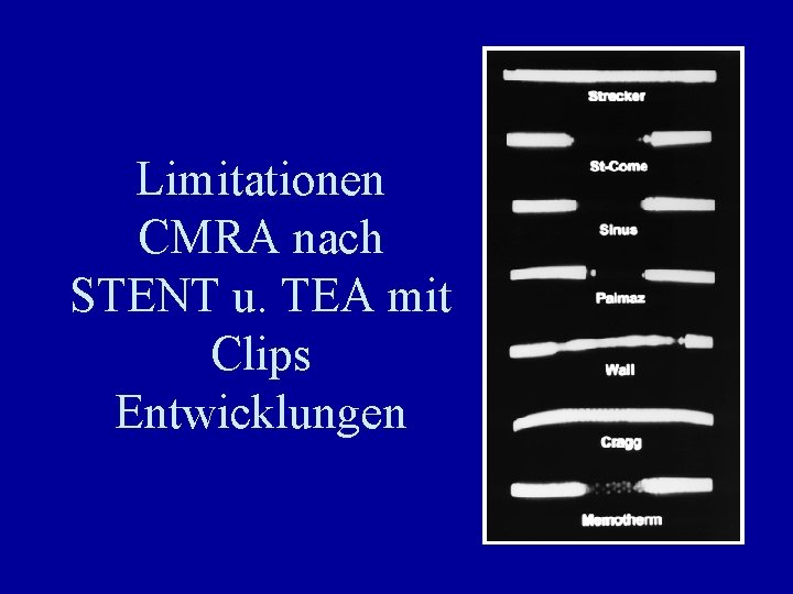 Limitationen CMRA nach STENT u. TEA mit Clips Entwicklungen 