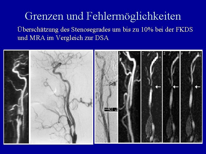 Grenzen und Fehlermöglichkeiten Überschätzung des Stenosegrades um bis zu 10% bei der FKDS und