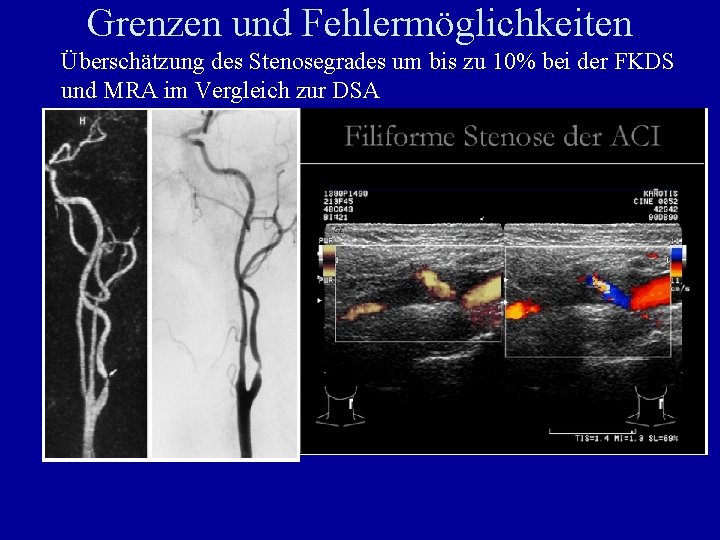 Grenzen und Fehlermöglichkeiten Überschätzung des Stenosegrades um bis zu 10% bei der FKDS und