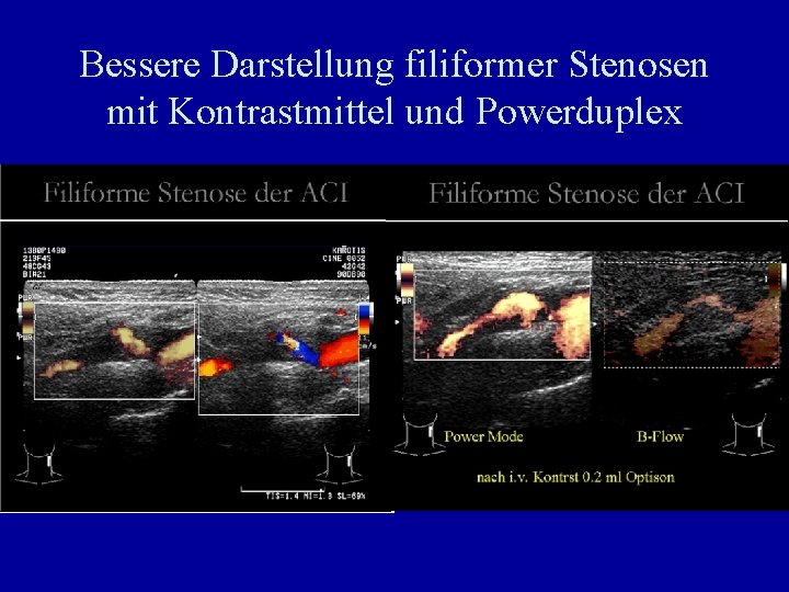 Bessere Darstellung filiformer Stenosen mit Kontrastmittel und Powerduplex 