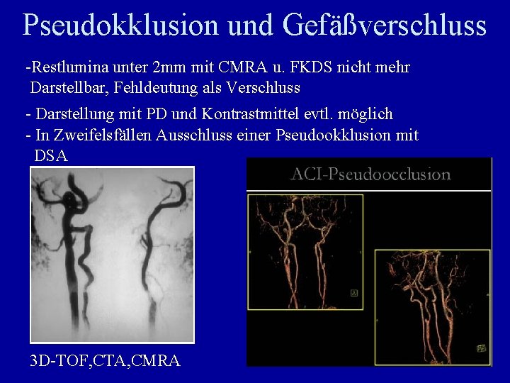 Pseudokklusion und Gefäßverschluss -Restlumina unter 2 mm mit CMRA u. FKDS nicht mehr Darstellbar,