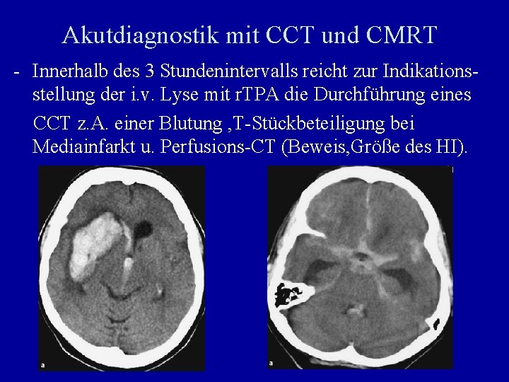 Akutdiagnostik mit CCT und CMRT - Innerhalb des 3 Stundenintervalls reicht zur Indikationsstellung der