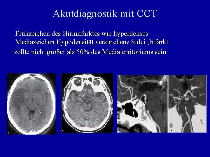 Akutdiagnostik mit CCT - Frühzeichen des Hirninfarktes wie hyperdenses Mediazeichen, Hypodensität, verstrichene Sulci ,