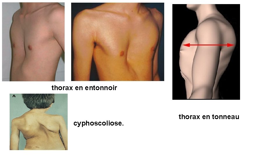 thorax en entonnoir cyphoscoliose. thorax en tonneau 