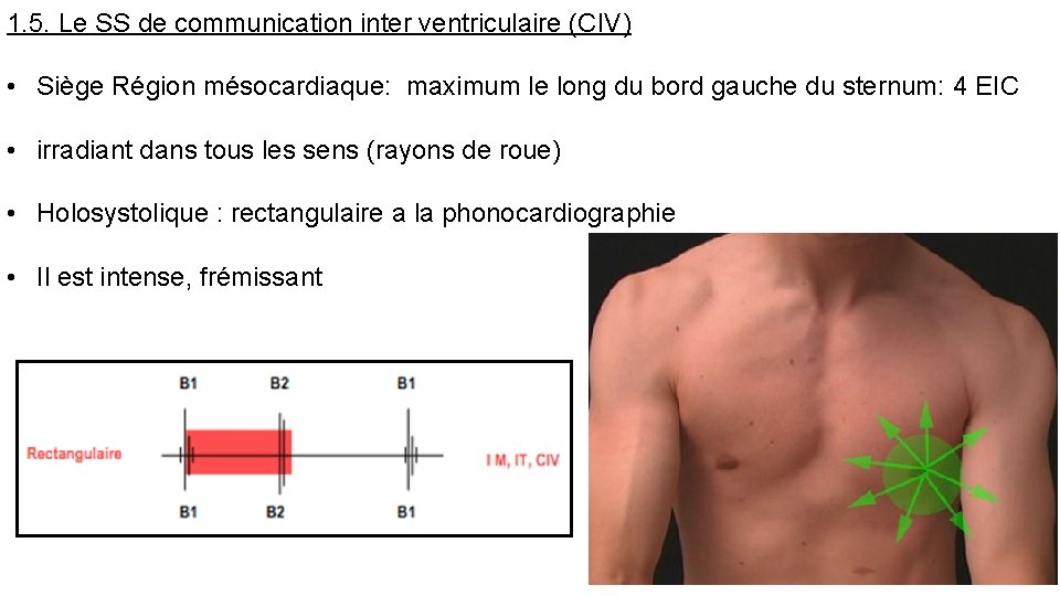 1. 5. Le SS de communication inter ventriculaire (CIV) • Siège Région mésocardiaque: maximum