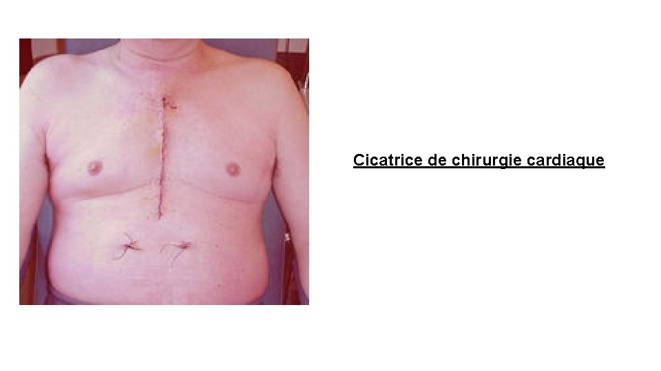 Cicatrice de chirurgie cardiaque 