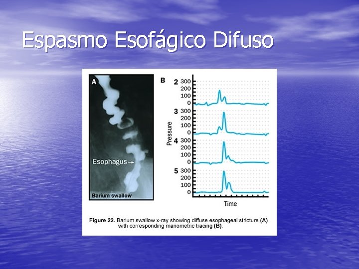 Espasmo Esofágico Difuso Espasmo Esofágico Difuso