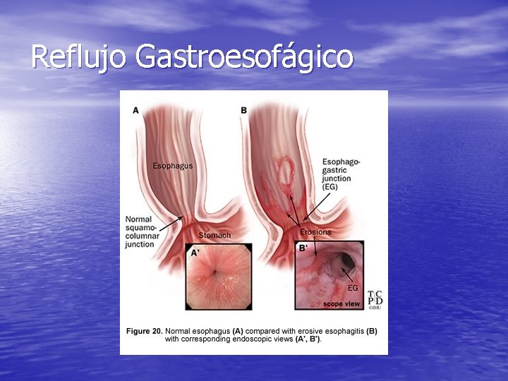 Reflujo Gastroesofágico Reflujo Gastroesofágico