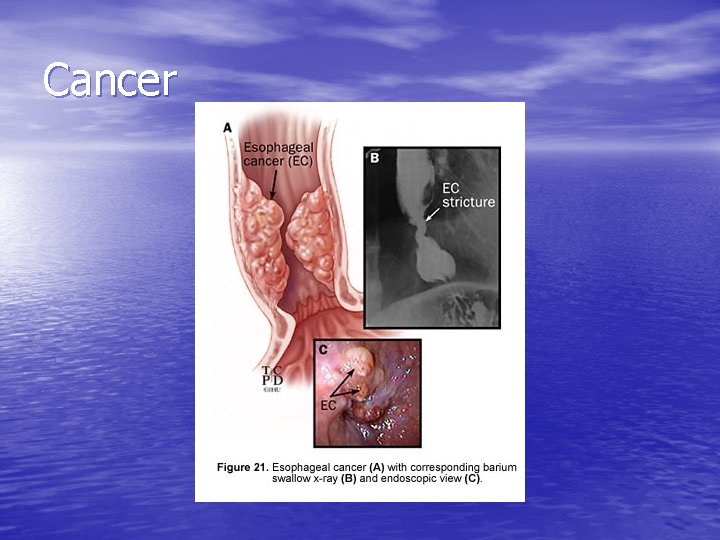 Cancer Cancer