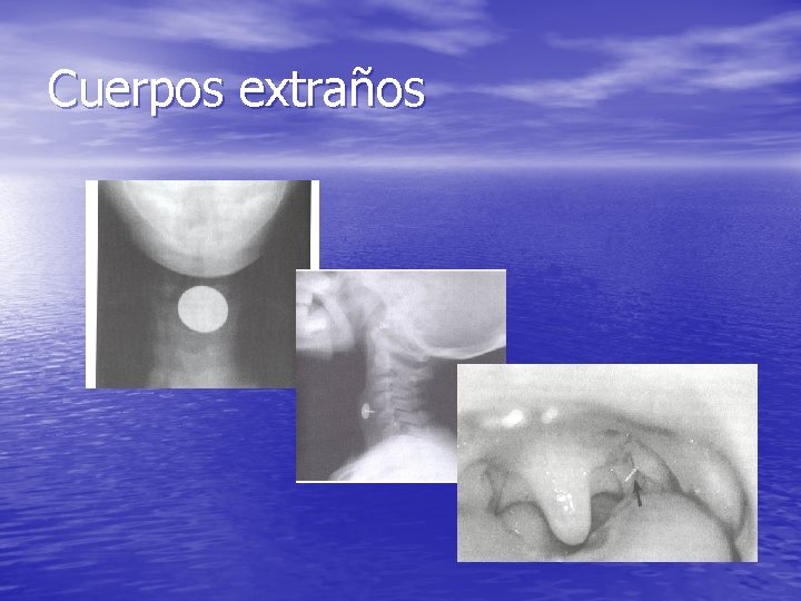 Cuerpos extraños Cuerpos extraños