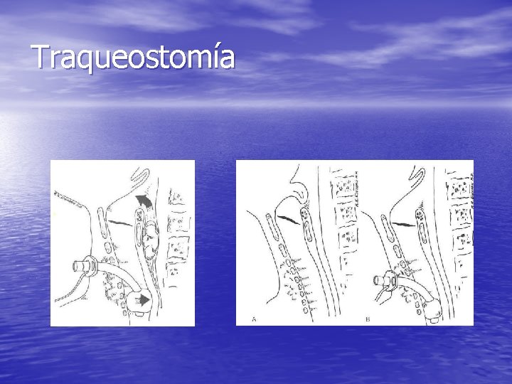 Traqueostomía Traqueostomía