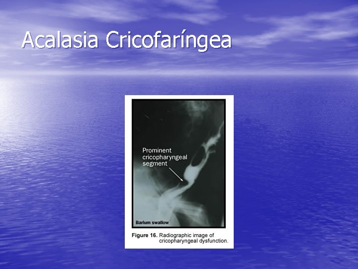 Acalasia Cricofaríngea Acalasia Cricofaríngea