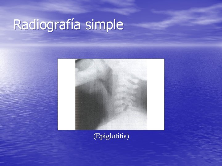 Radiografía simple (Epiglotitis) Radiografía simple (Epiglotitis)
