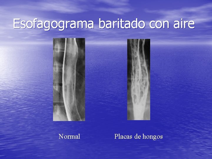 Esofagograma baritado con aire Normal Placas de hongos Esofagograma baritado con aire Normal Placas de hongos