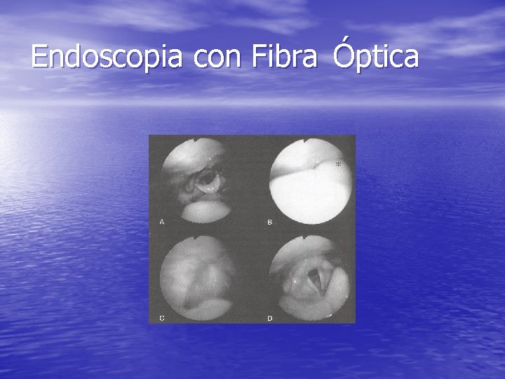 Endoscopia con Fibra Óptica Endoscopia con Fibra Óptica