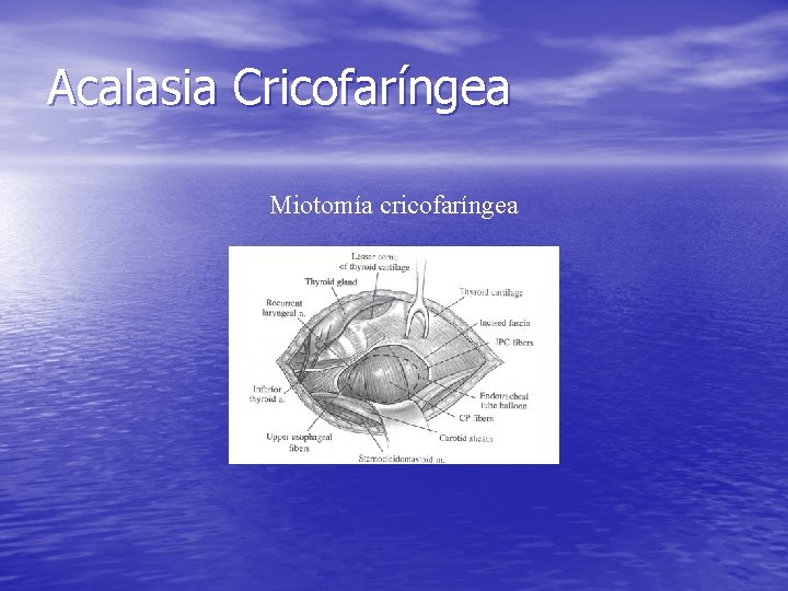 Acalasia Cricofaríngea Miotomía cricofaríngea Acalasia Cricofaríngea Miotomía cricofaríngea