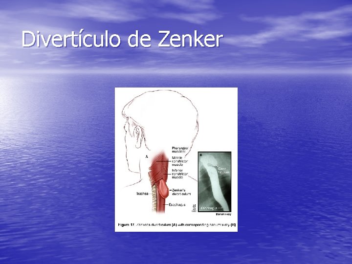 Divertículo de Zenker Divertículo de Zenker