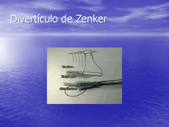 Divertículo de Zenker Divertículo de Zenker